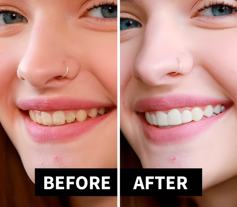 Shiny Smile Veneers 5