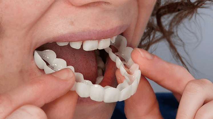 Shiny Smile Veneers 12