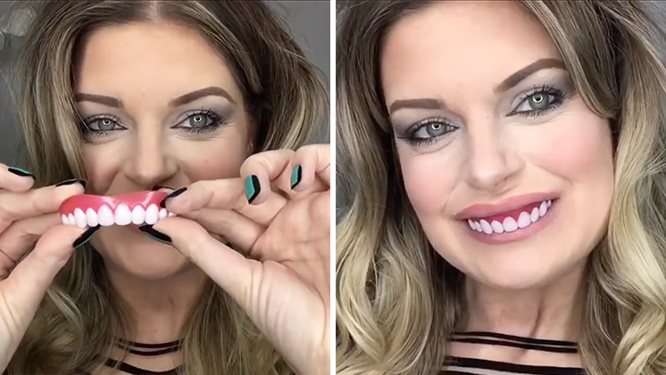 Shiny Smile Veneers 17