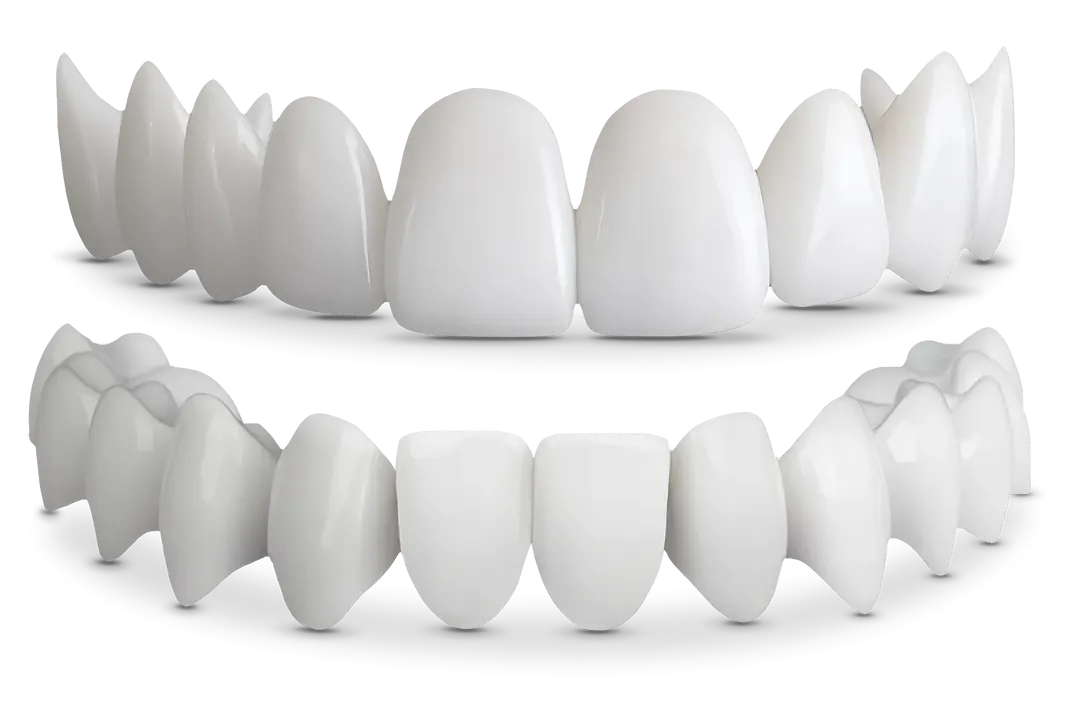 Shiny Smile Veneers 2