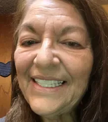 Shiny Smile Veneers 9