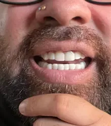 Shiny Smile Veneers 8